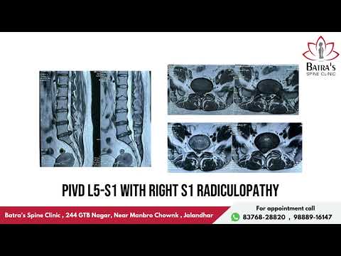 Video thumbnail: Patient testimonial – Dr Sahil Batra