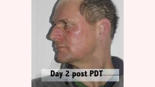 Day 2 post PDT
