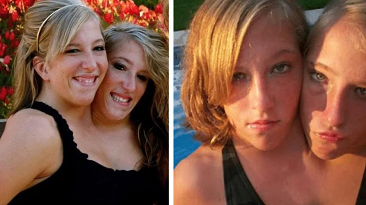 The Conjoined Twins Who Just Turned 30 Years Old H...