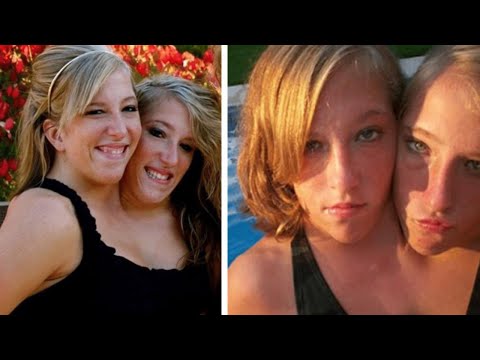 The Conjoined Twins Who Just Turned 30 Years Old Have Made An Important Life Decision