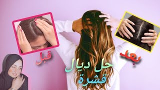 التخلص من قشرة الشعر بسرعه |علاج القشرة | وصفة الزاز السحرية  ناس لي كتعاني من القشرة المزعجة ?