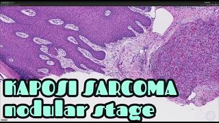 Kaposi Sarcoma Nodular Stage Mimicking Pyogenic Granuloma