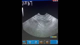 Moderate collection of free fluid in pelvic cavity
