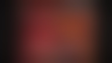 SA-4 LAPAROSCOPIC PARTIAL NEPHRECTOMY-ZERO ISCHEMIA- SERDAR AYKAN, MD