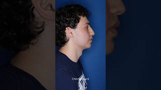 5 weeks post chin augmentation with Dr. Stong. Large implant for a defined masculine jawline.