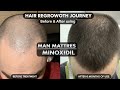 man matter minoxidil review tamil #manmatters #tamil  #hairstyle #hair
