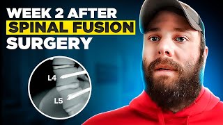 Beginning the Journey: What To Expect in Weeks 1 & 2 after L4L5 Spinal Fusion Recovery