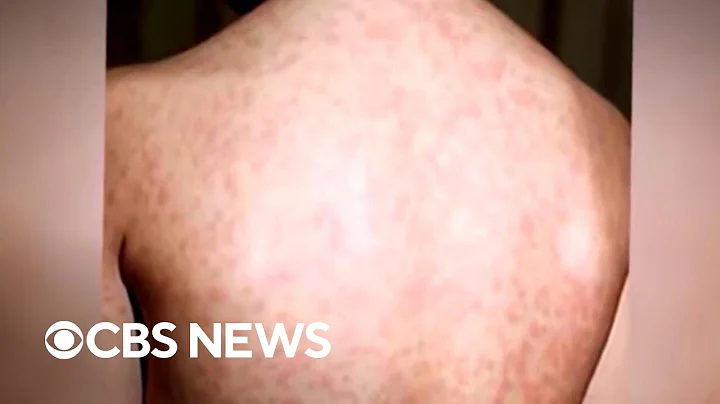 Texas measles outbreak grows
