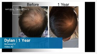 1 Year Hair Transplant Results for Crown and Norwood 4 Hair Loss | Dr. Blumenthal (Dylan)