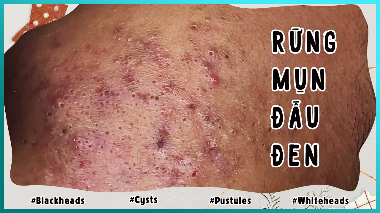 Big Cystic Acne Blackheads Extraction Blackheads & Milia, Whiteheads Removal Pimple Popping