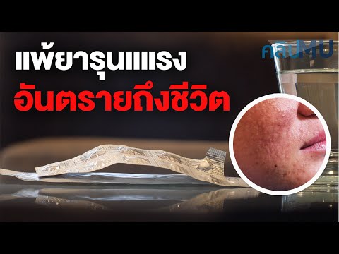 แพ้ยารุนแแรง อันตรายถึงชีวิต | คลิป MU [Mahidol Channel]