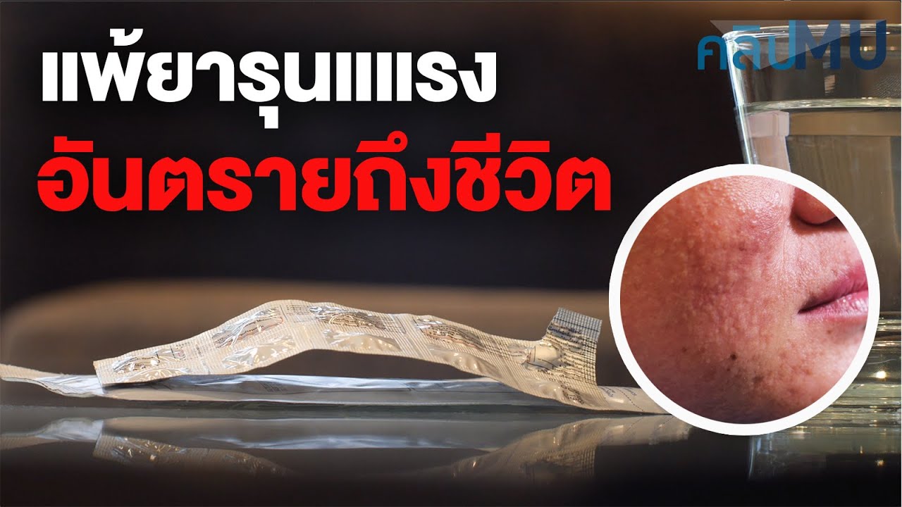 แพ้ยารุนแแรง อันตรายถึงชีวิต | คลิป MU [Mahidol Channel]