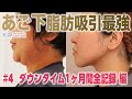 【永久保存】あご下脂肪吸引ダウンタイム全部見せ！食事は？会話は？お仕事は？｜美ボディラインch#24