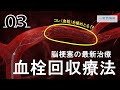 ユーチューブ医療講座「脳卒中のお話」～第3回脳梗塞の治療～
