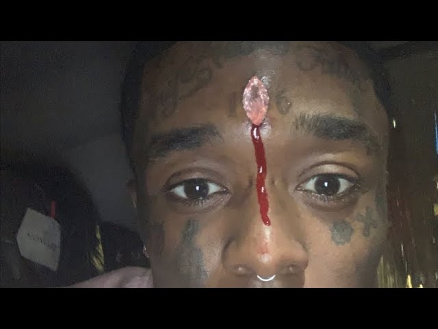 Lil Uzi Vert Could Die because his diamonds face implant he said on his twitter page