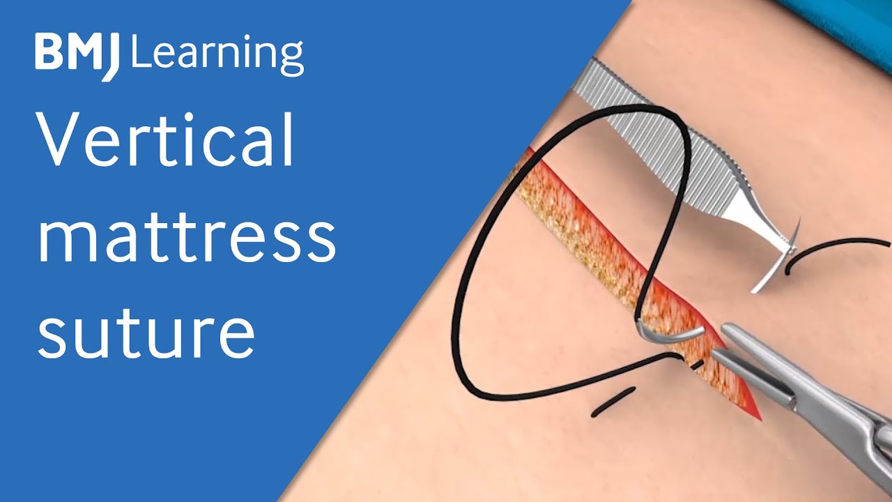 Vertical Mattress Suture  BMJ Learning