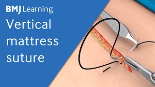 Vertical Mattress Suture | BMJ Learning