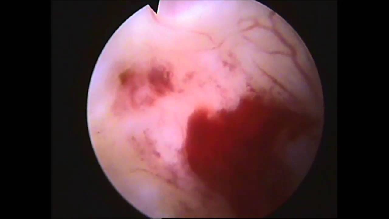 Несостоятельность рубца после КС, эндометриоз рубца