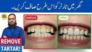 Danto Se Tartar/Plague Ka Khatma! Home Remedies for Tartar Removal | Dr. Ibrahim screenshot 4