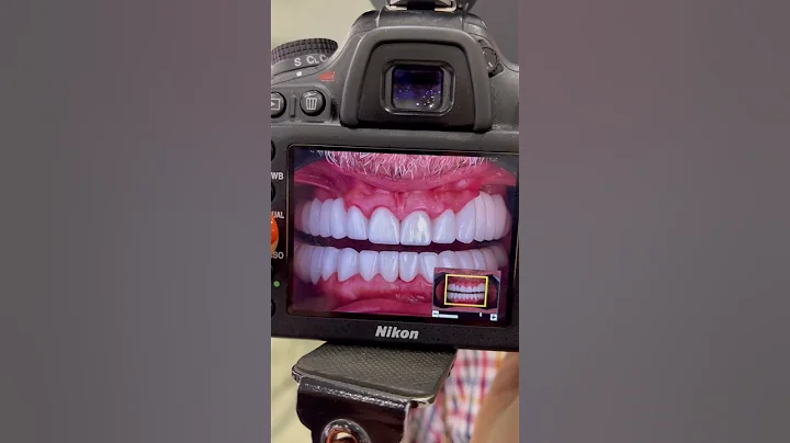HOLLYWOOD SMILE #dentist #cosmeticdentistry #dental #teeth #hollywoodsmile