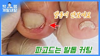 안보이는 파고드는발톱, 아무리 혼자 잘라도  계속 아파서 커팅만 하시러 방문 ingrown toenail cutting [풋스올영등포당산점]