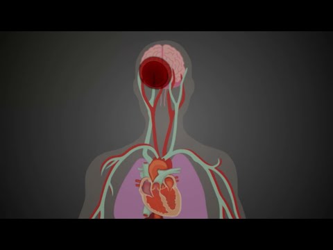 Cómo Prevenir una