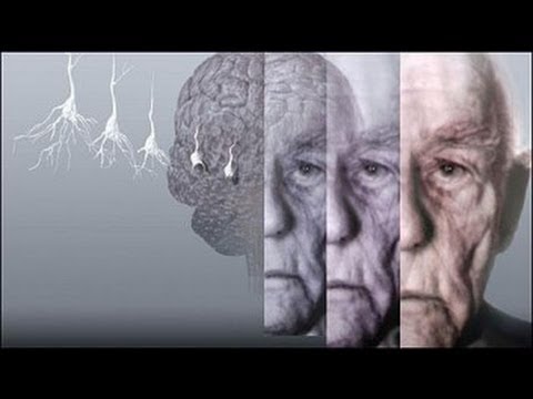 Видео: Може ли фронтотемпоралната деменция да ви убие?