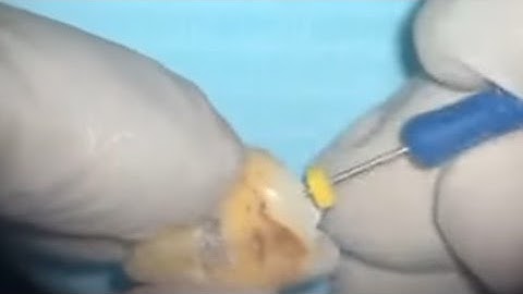 Apical gauging || How to select master cone Gutta percha ( fitting master cone)