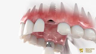 Canine Tooth Implant
