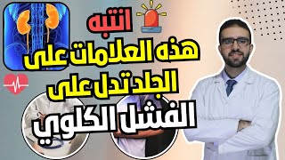 علامات تظهر على الجلد تدل على الفشل الكلوي || اعرفها في اقل من دقيقتين!