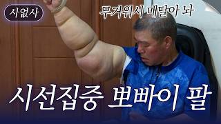 "Lymph fluid just leaks out." One arm weighs 8.4kg? The sad story of a man with Popeye arms | Unt...
