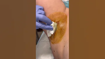 High Pressure Abscess POPPED 208SkinDoc 