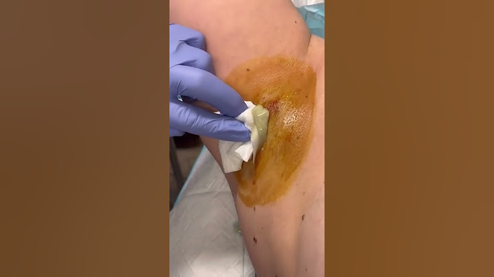 High pressure abscess POPPED! | 208SkinDoc