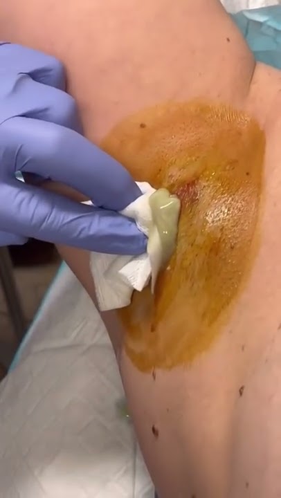High pressure abscess POPPED! | 208SkinDoc