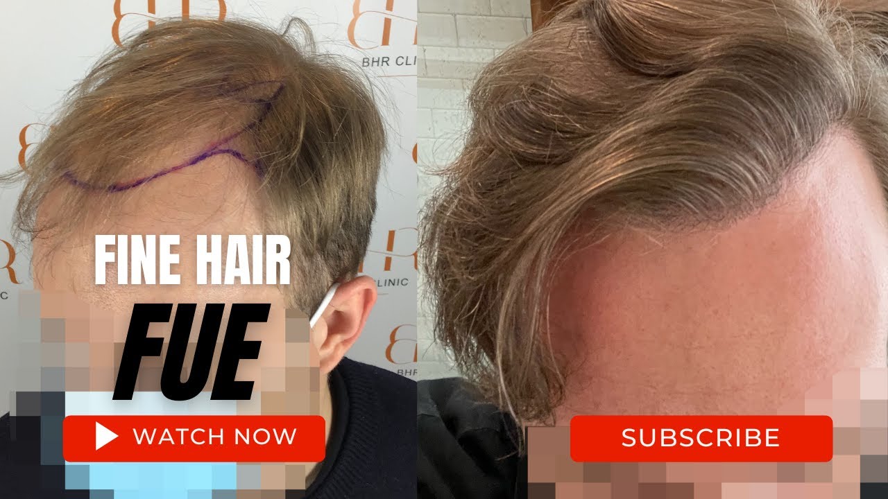 FUE Hair Transplant Results Fine Haired Patient Documents Healing To FUE Hair Transplant Results Fine Haired Patient Documents Healing To