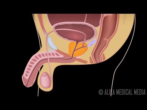 Benign Prostatic Hyperplasia (BPH) and Treatments, animation.