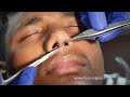 Rhinoplasty Before and After - Rhinoplasty | Nose Job Before After Experience - Dr. Sunil Richardson