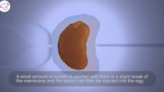 Ela - Process of ICSI Treatment