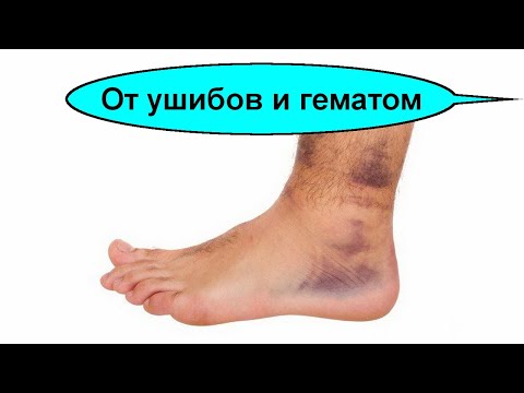 Как лечить ушибы и гематомы в домашних условиях