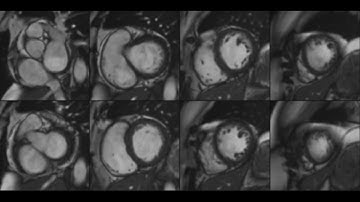 Arrhythmogenic Cardiomyopathy