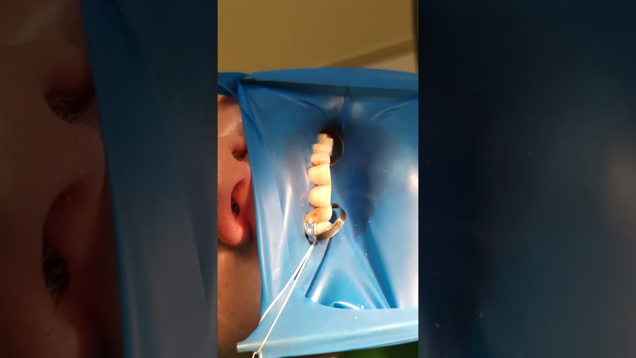 Isolation 13-26 teeth.#cofferdamrubber #раббердамология