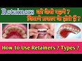 HOW TO USE RETAINERS? (HINDI) | TYPES OF RETAINERS