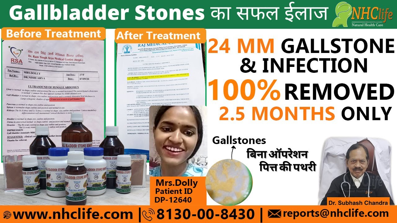 पित्त की थेली की पथरी सफल ईलाज Mrs Dolly Homeopathic & Ayurvedic