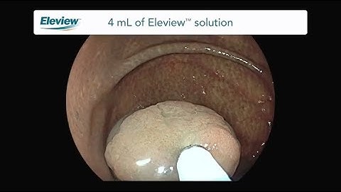 Endoscopic Polypectomy with Eleview™