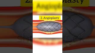 heartattack angioplasty full video is in my you tube channel