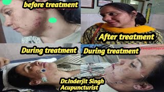 Acupuncture treatment is the best mode for cosmetics.            Benefits of Cosmetic Acupuncture
