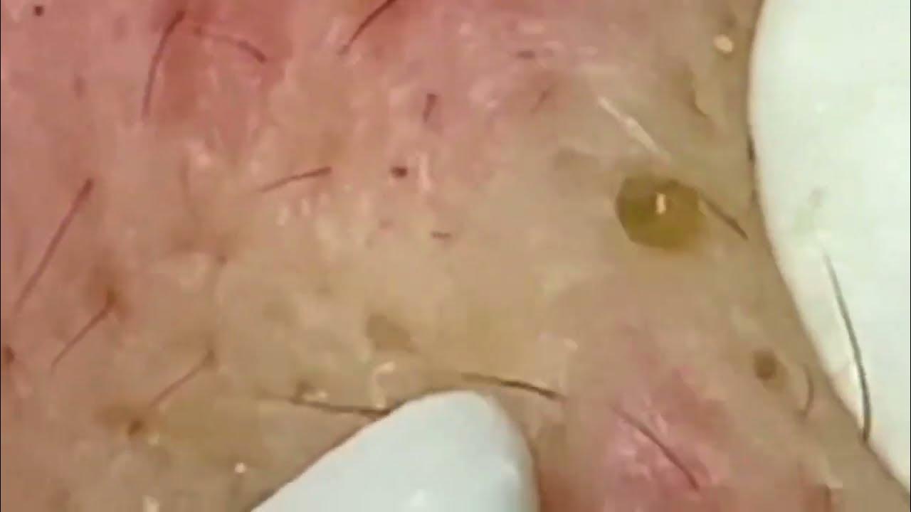 Super deep blackhead removal 42 YouTube