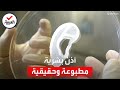 عملية فريدة نجاح زراعة أذن بشرية بتقنية طباعة ثلاثية الأبعاد 