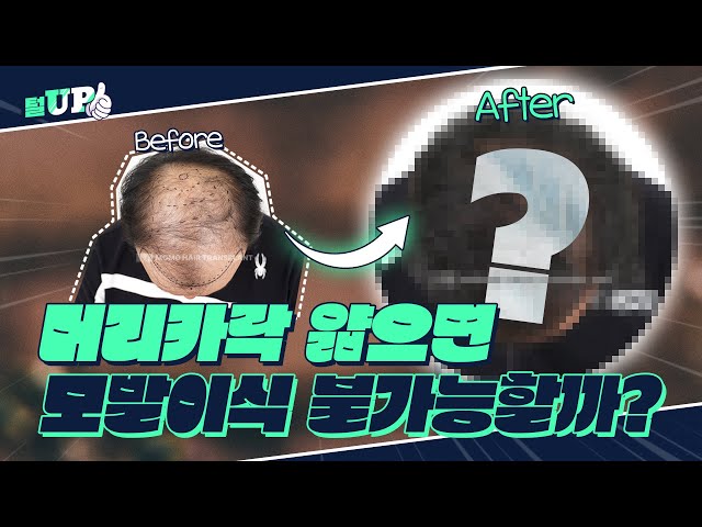 모발이식 가능케이스, 불가능케이스 2편 👀알아보기👀ㅣ모모성형외과ㅣ김승준 대표원장