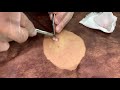 粉瘤くりぬき法 40代女性背中epidermal cyst atheroma cystic acne extractions lipoma大阪心斎橋 大阪梅田院 名古屋院 福岡院